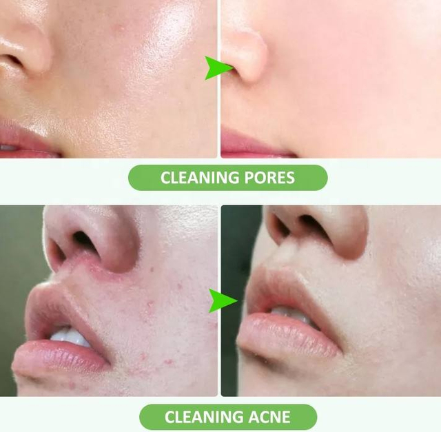 Custom Natural Acne Face Wash Bubble Skincare Cleanser For Hydrating Skin Care Cleansing